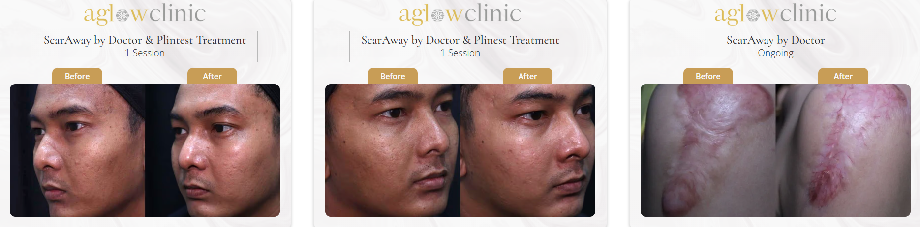 Acne scar before and after KL result 1